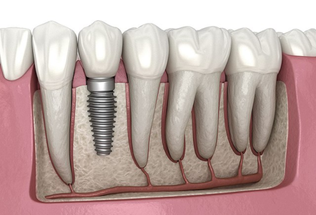 The Process and Benefits of Getting Dental Implants in Teddington